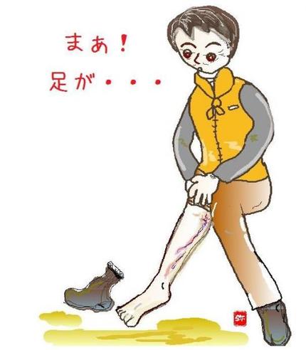 足に静脈瘤が出来てしまったときにするお灸