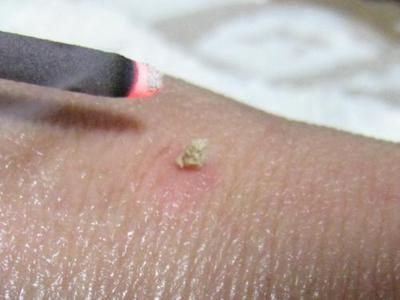 虫刺されには、お灸が一番!