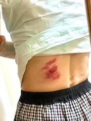 擦傷部位にラップ&オロナイン…閲覧要注意です❗️ 擦傷部位にラップ&オロナイン…閲覧要注意です❗️