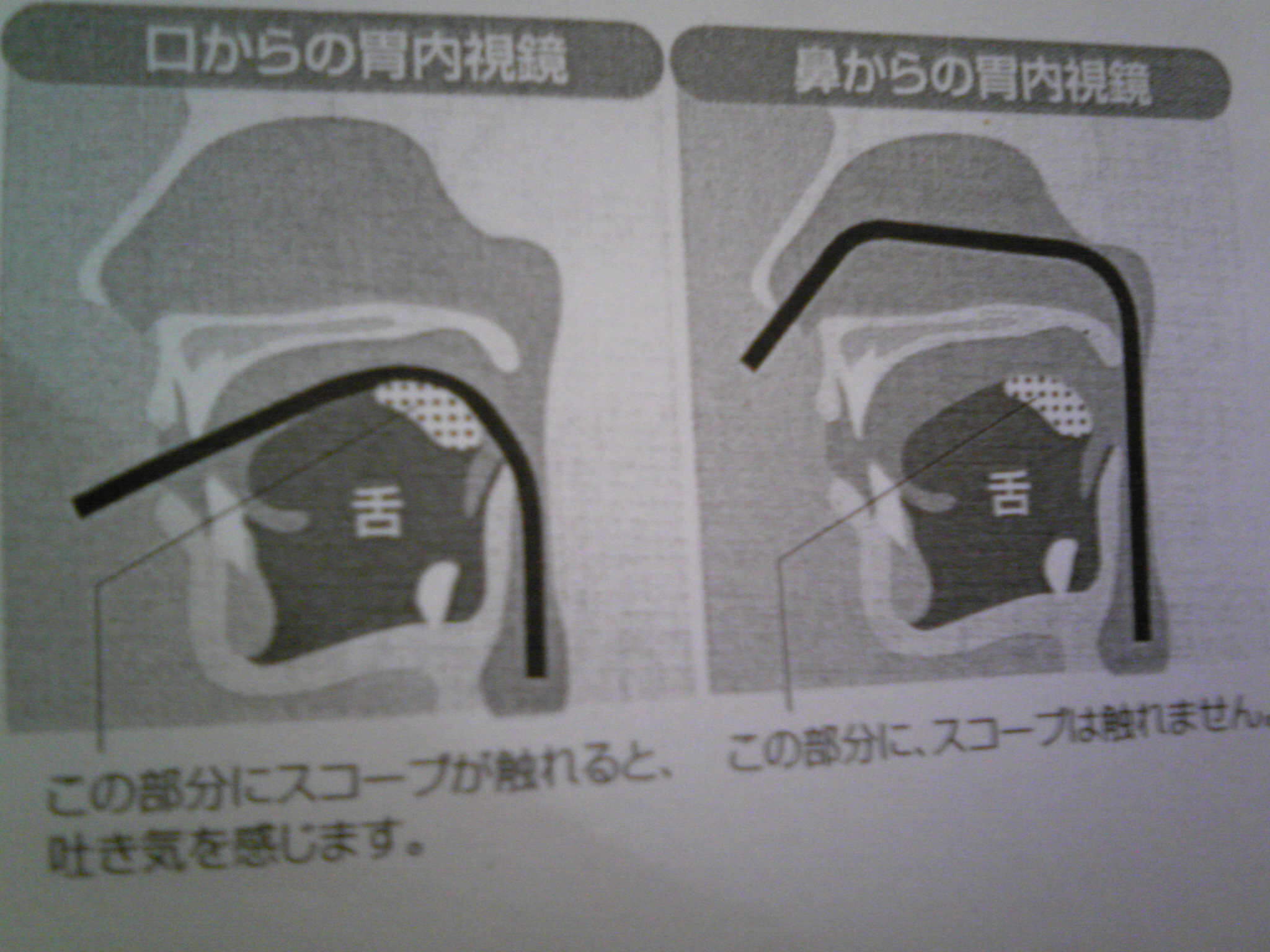 胃カメラ検査