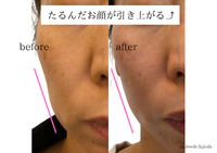 たるみ顔に。ゆるんだ肌に。マロウドの【たるみケアフェイシャル】
