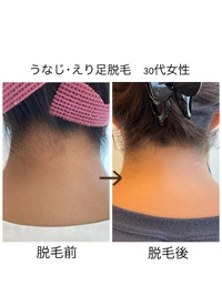 えり足脱毛【画像あり】M様30代女性