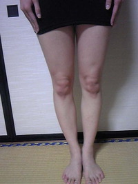 【骨盤美脚バンテージ】Before＆After